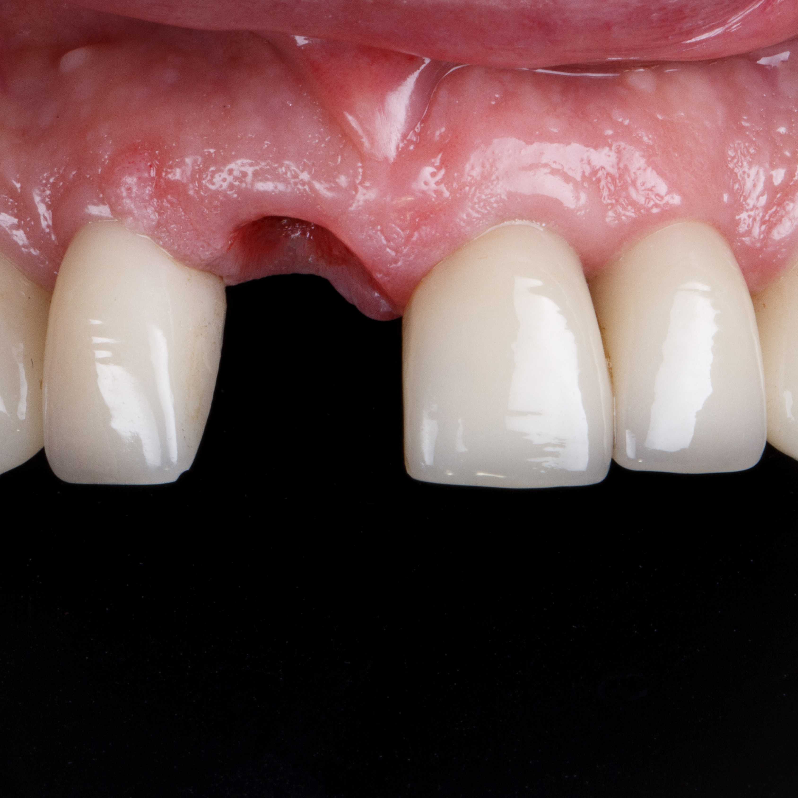 Antes do tratamento - Dente ausente