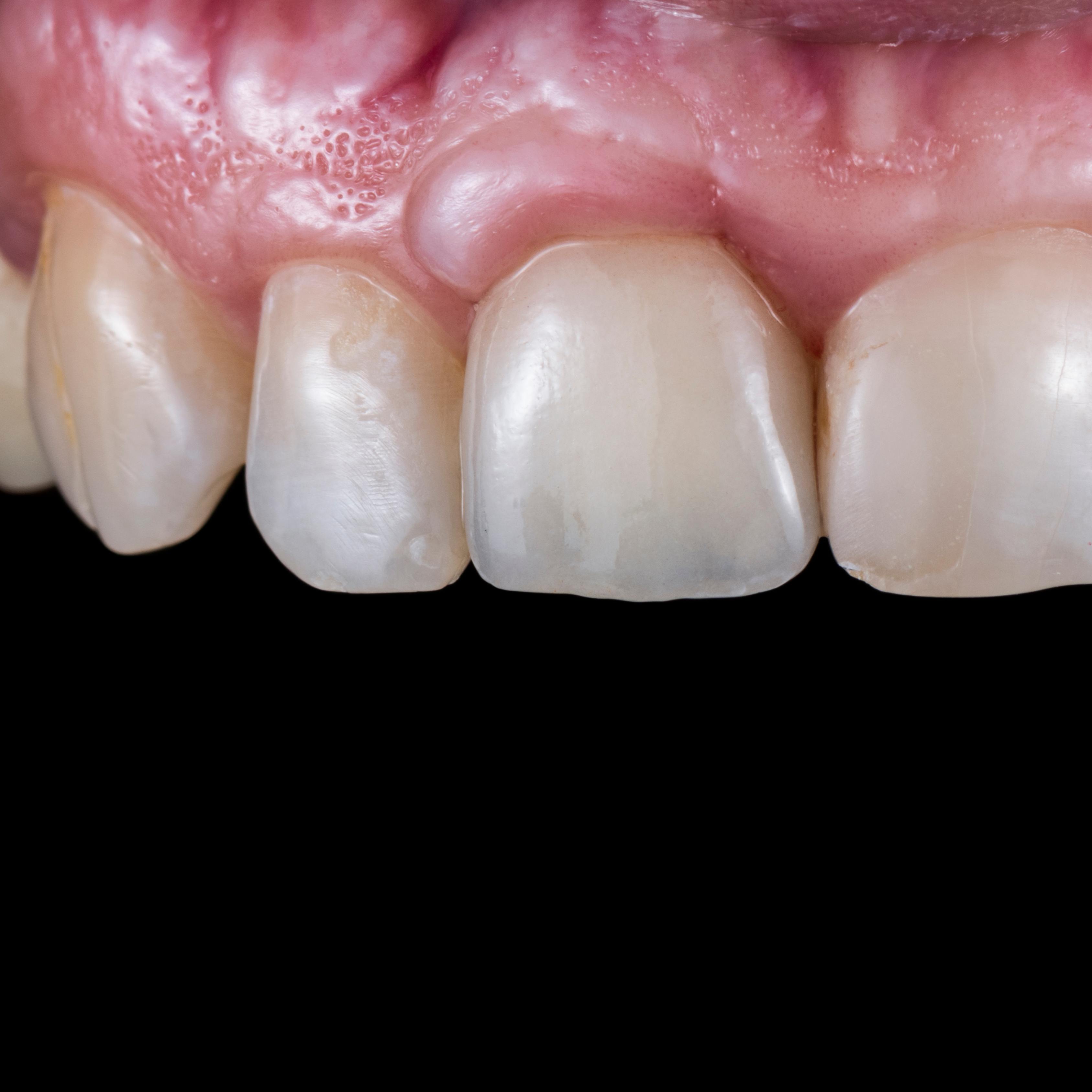 Depois do tratamento - Sorriso restaurado